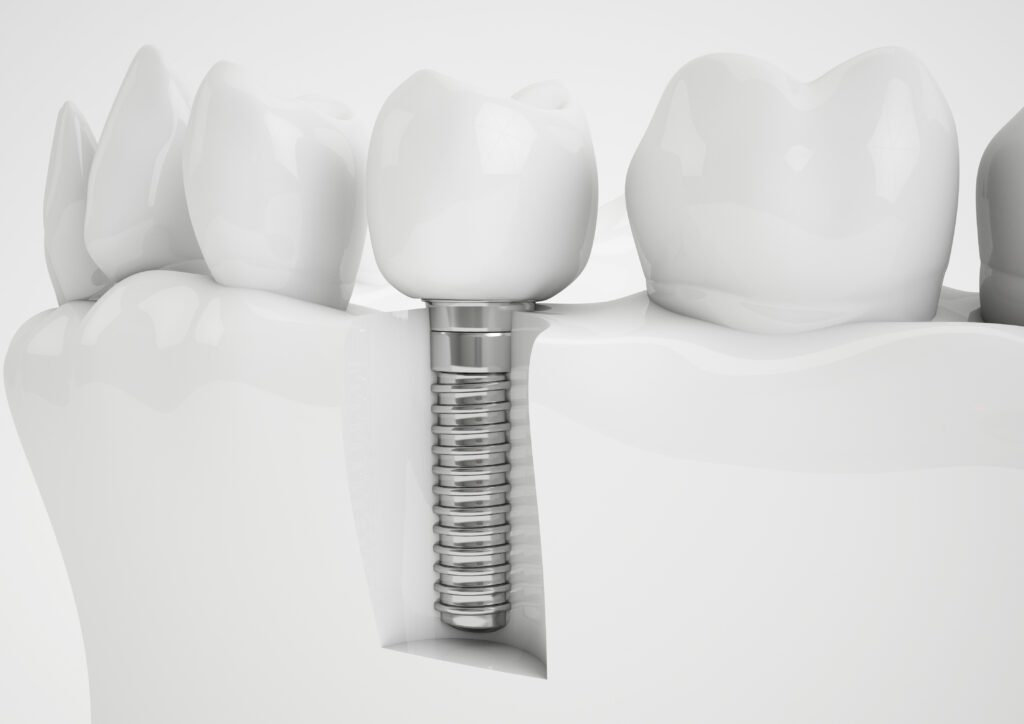IMPLANTE DENTÁRIO