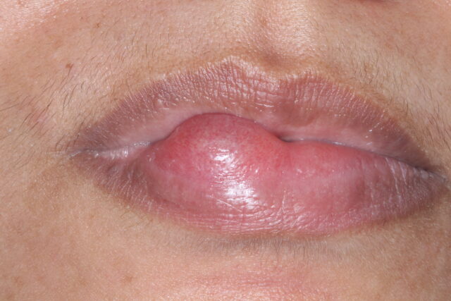 Bolha na boca (mucocele): por que aparece e quando tratar?