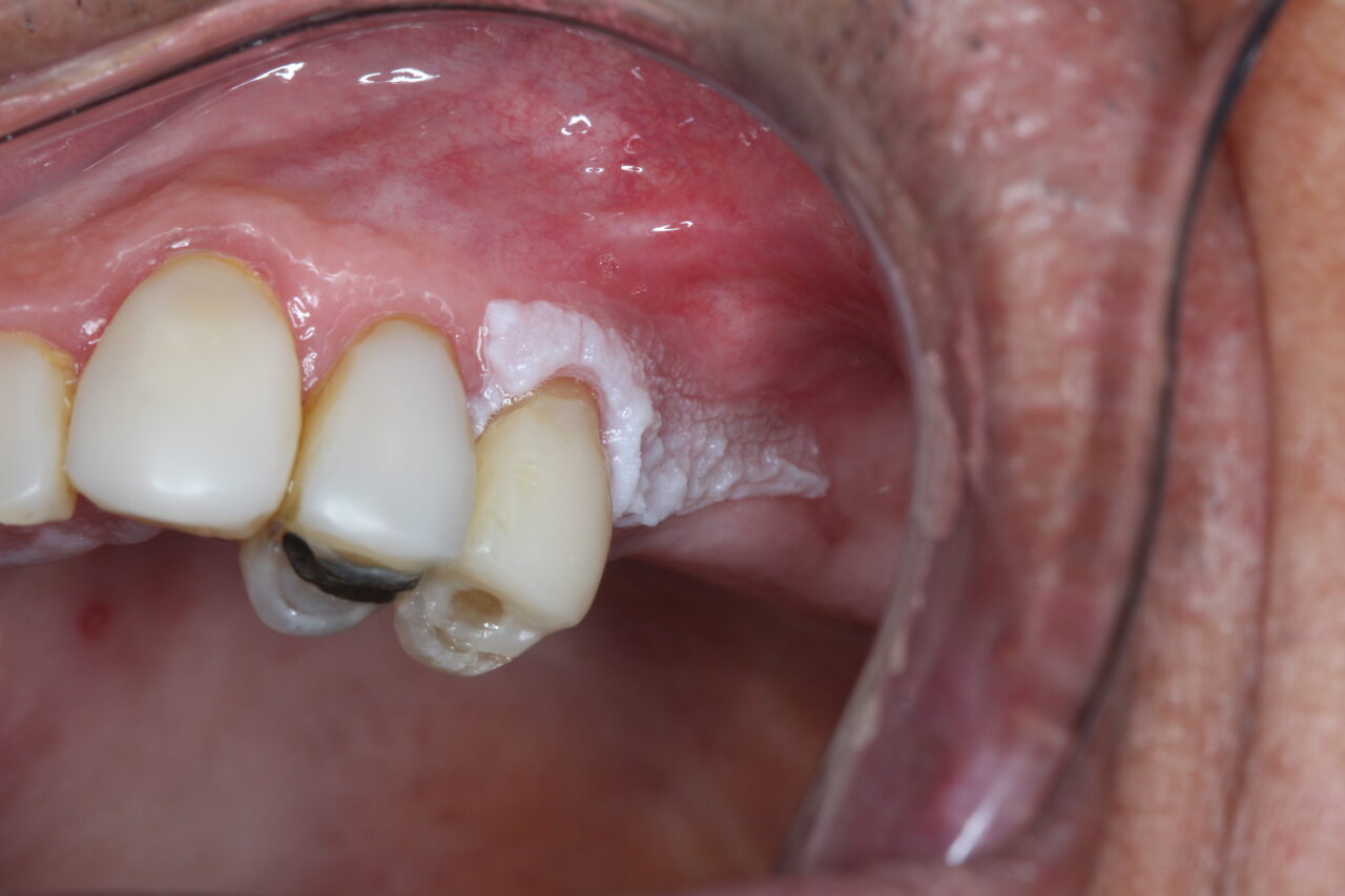 Mancha branca na boca (leucoplasia): o que pode ser e o que fazer?