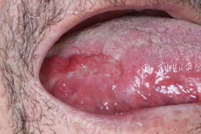 Ferida na boca que não cicatriza: quando é sinal de alerta?