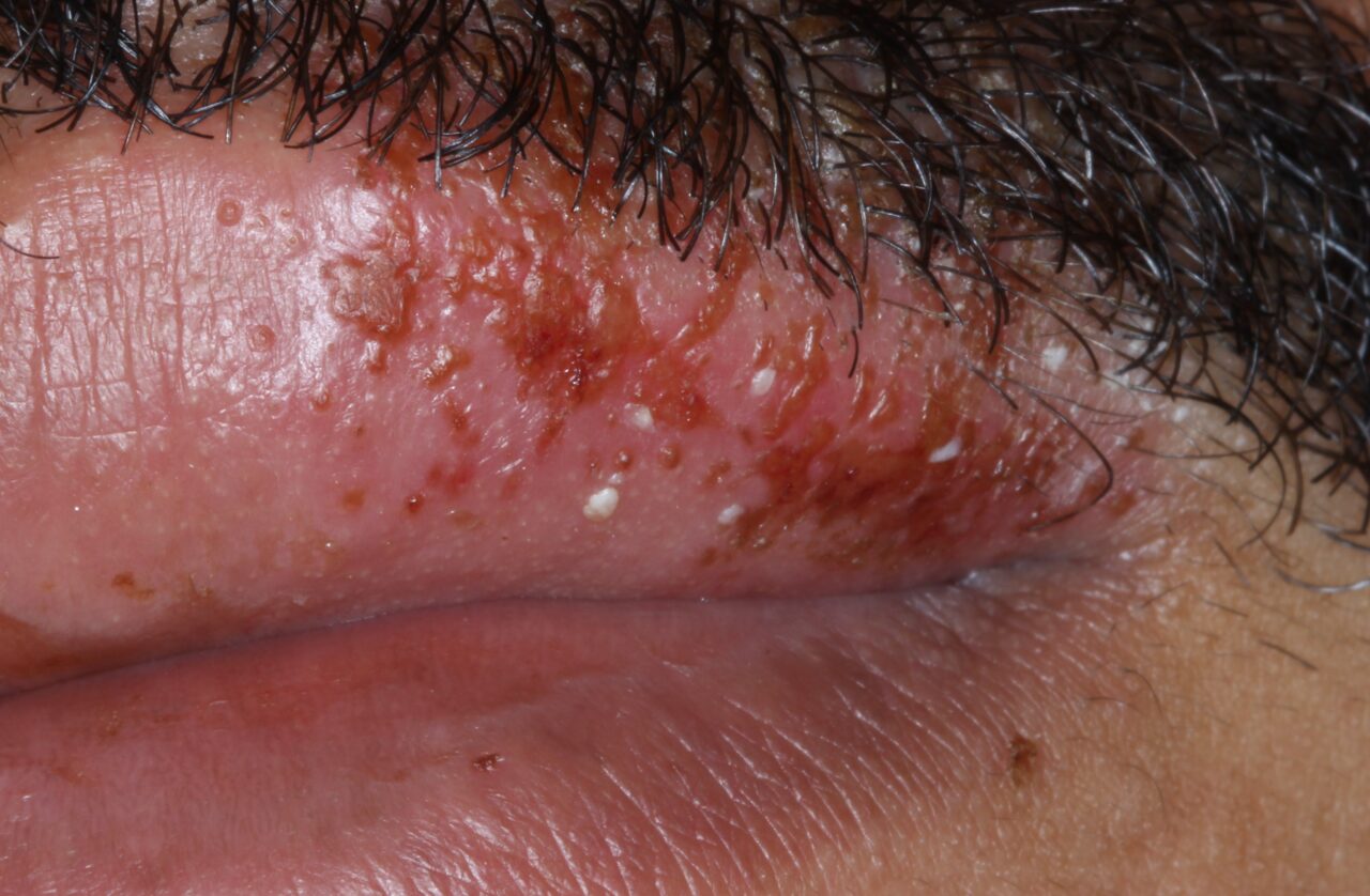 Herpes labial e na boca: como reconhecer e evitar recorrências?