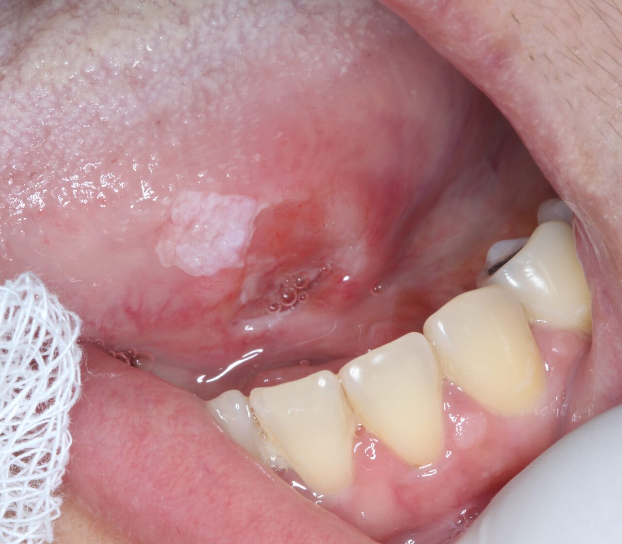 Câncer de boca: quais são os primeiros sinais e como prevenir?