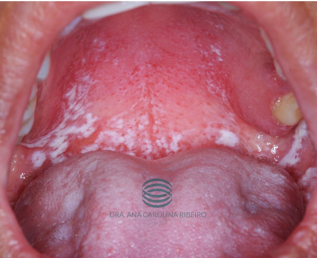 Candidíase oral: placas brancas na língua e ardência são fungo?